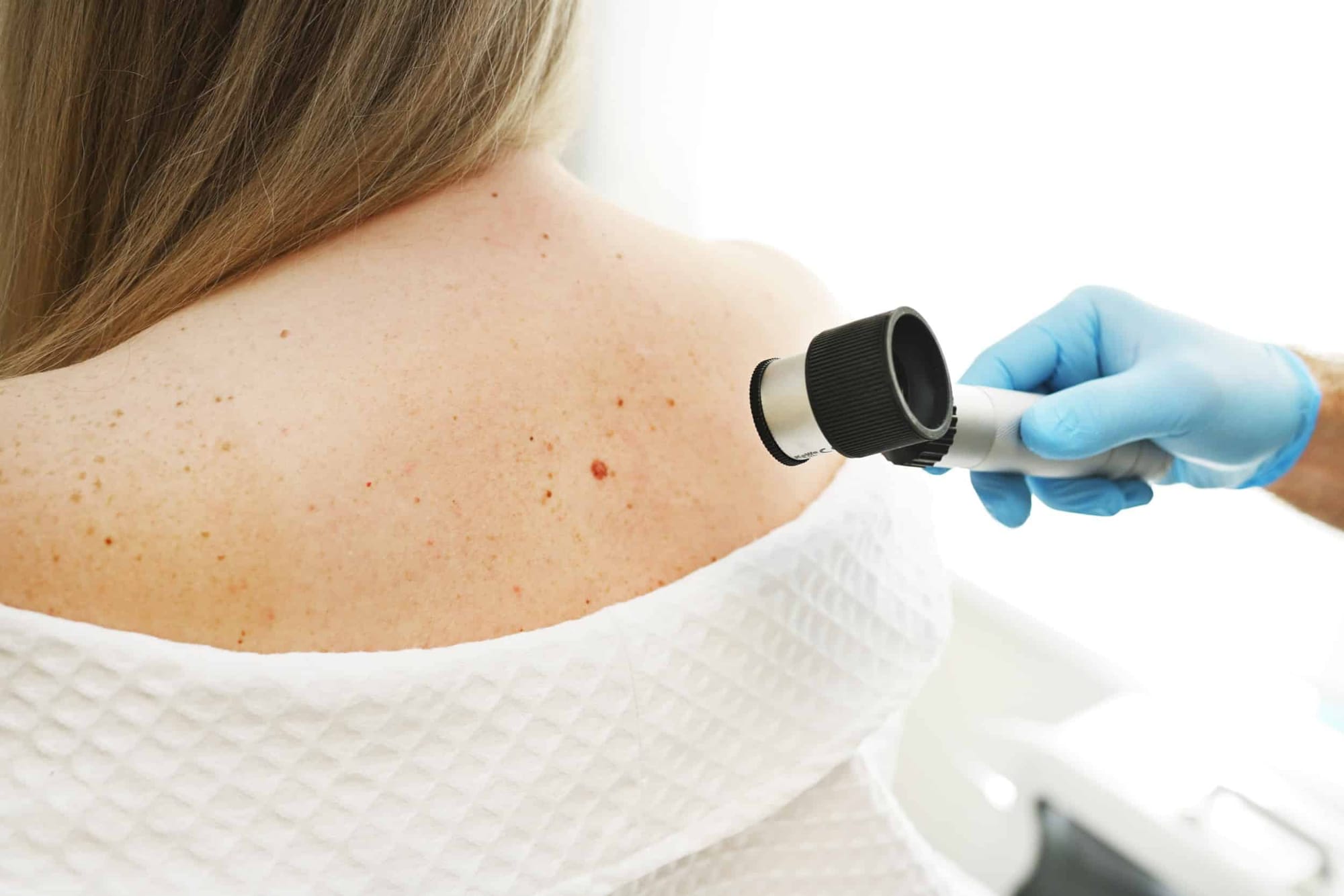 Stock photograph of models: a gloved clinician holds a dermatoscope to the freckled shoulder of a woman with long fair hair, a white robe lowered off her back